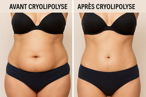 Avant après cryolipolyse