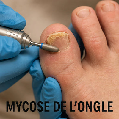 Ponceuse ongle pied mycose